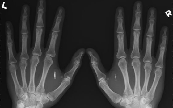 体内NFC芯片植入:肉身情报升级版|NFC芯片|芯