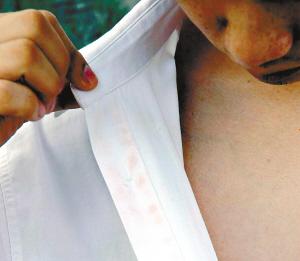男子患汗血怪病出汗汗水可染红衣服(图)