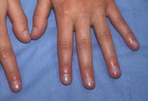 透过指甲看健康:白指甲预示肝病问题(图)_科学