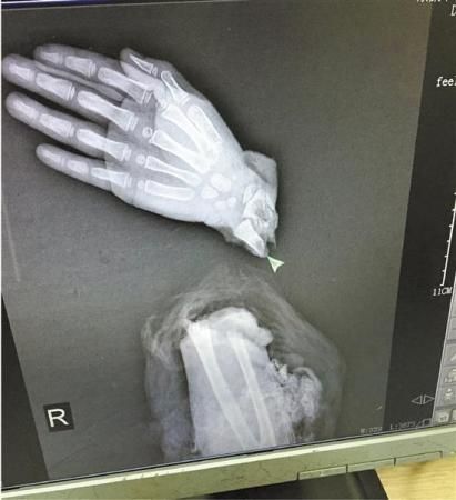  Girl injured wrist