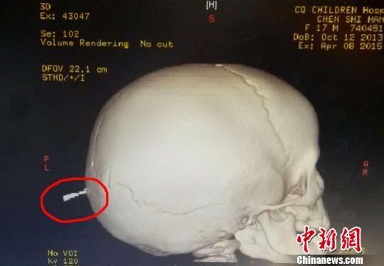  From the CT of Han Han (a pseudonym), it is obvious that the windmill metal nail is inserted into the back of the head. Photos provided by Children's Hospital