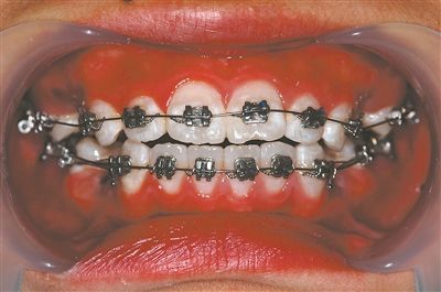 图是临床上使用经典的固定矫治器(钢牙套),由不锈钢制造.