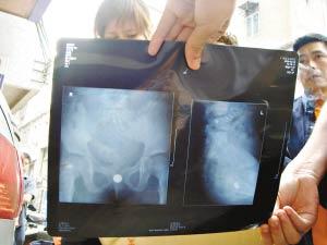 六岁女童下体被塞入电池