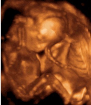 怀孕第18周胎儿图