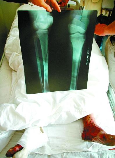 惠安:没钱付嫖资乱棍打断腿