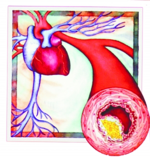 国产心脏射频消融导管造福心律失常患者