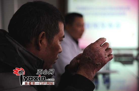 新疆职业病医院成功救治一例罕见特重度烧伤病