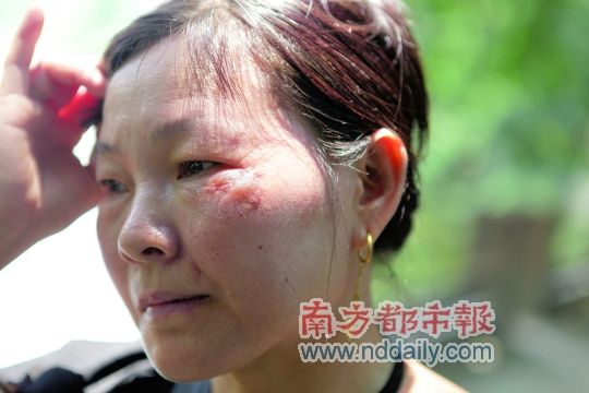 被老板的狗咬伤女员工索整容费
