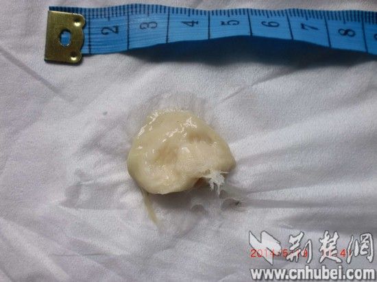 女子在武汉161医院手术半月后发现鼻内遗留一