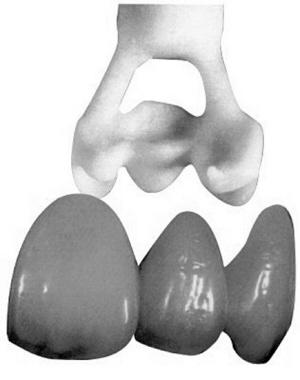 很多人说装烤瓷牙后出现荨麻疹肾病