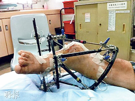 畸腿少年来港求医 3D支架矫正后行走自如(图)