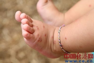 金大地化工周边村民家中幼儿身上基本上都出现了皮肤过敏的症状，村民去医院诊断后，医生称系空气污染所致。(中国经济网 陈逸鸣摄于7月12日)