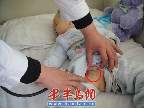 通过穿刺患儿大腿内侧股静脉