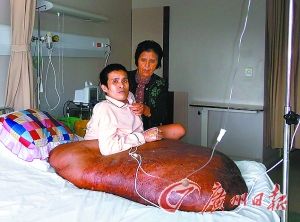 越南男子手术去除巨瘤