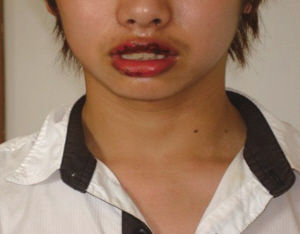 17岁小伙漂唇 不幸成了香肠嘴