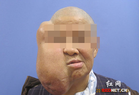 ��Ѯ�ϸ������ٳ�һ����ͷ���г���ҽ������ֲƤ����