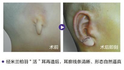 最强专家团队 让活耳再造不是梦