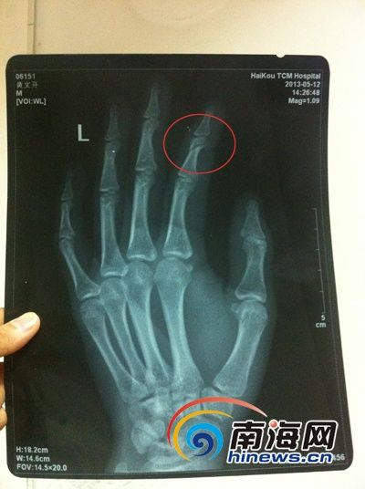海口:男子工伤致食指骨折 向公司索赔偿[图]