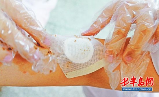 三伏贴明起开贴 孕妇肺结核咳血患者禁用(图)