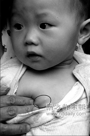 10个月大女婴胸中检查出钢针(组图)