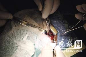 医生用眼科手术器械为早产儿做心脏手术(组图
