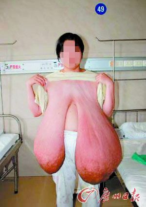 长出43斤巨乳(图)