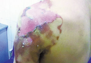 技师操作失误 男子拔火罐造成深二度烧伤