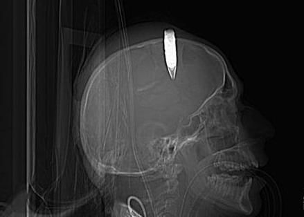 一名士兵的头部嵌入子弹的X光片（资料图）