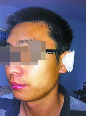 昨天记者看到男孩戴着黑框眼镜，左耳朵治疗后，被白色纱布包扎着