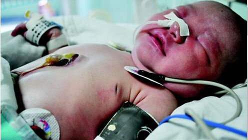 新生儿心脏外露父亲瞒家人送诊 手术3小时获救