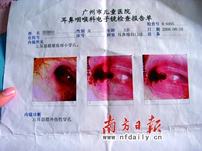 女童耳膜疑被幼儿园同学戳穿(图)