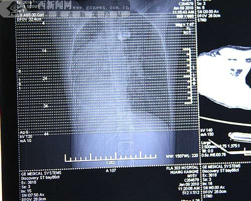 男孩内脏位置左右对调心脏手术难度极大(组图)