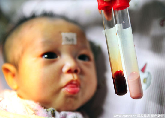 新生儿血液呈乳白色将对脏器造成极大影响(图)