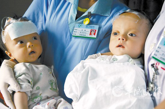 双胞胎兄弟因患脑积水被父母遗弃医院(图)