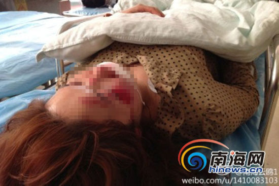孙女士被撞后陷入昏迷，脸部受伤严重。