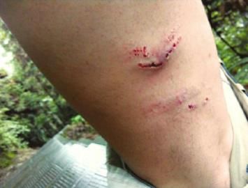 邓晓左大腿的两排伤口明显肿胀,并伴有出血.