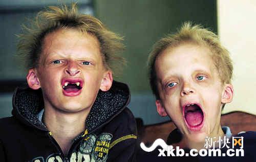 现实版吸血鬼!发育不良惹的祸