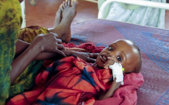 难民营中营养不良的孩子. 图片:世界粮食计划署