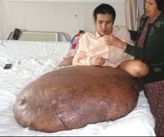 可能是该国历史上最大的肿瘤