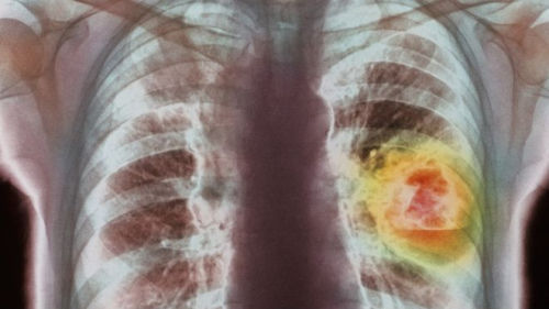 尽早诊断可以提高肺癌患者的存活率.