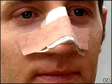 Lee Bowyer with a broken nose