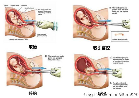 人工流产过程图