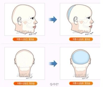 世界真奇妙 韩国掀起后脑勺整形风潮