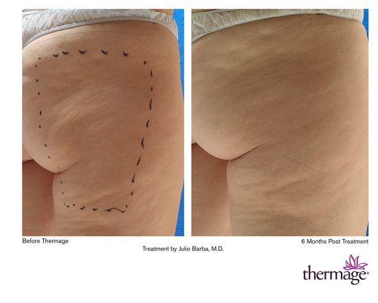 <em>热玛吉</em>_新浪健康_新浪网