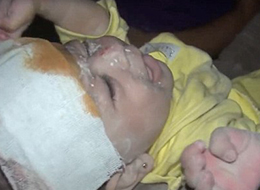 叙利亚女童战火中生还