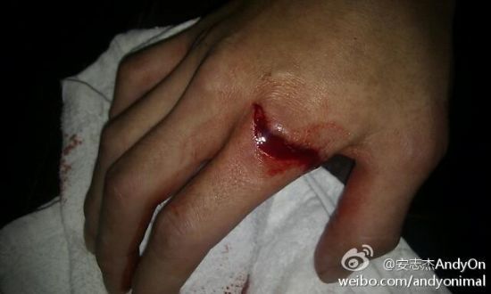 安志杰手部受伤的照片