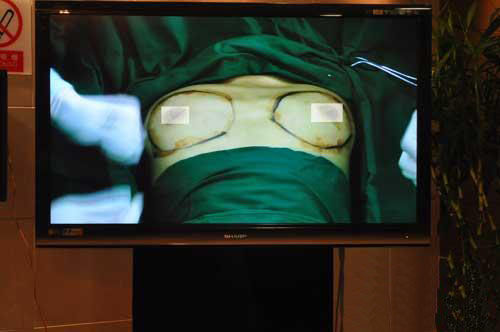 隆胸手术被直播 一场身体行为艺术展