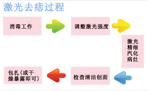 激光去痣过程示意图