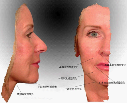 图4.拉皮术后5.5年的面部变化总结