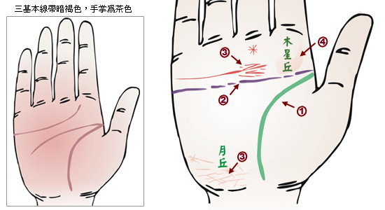 脑溢血手相